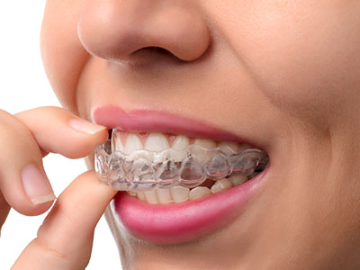 OB1 Dental | Veneers, Ceramic Crowns and Invisalign reg 